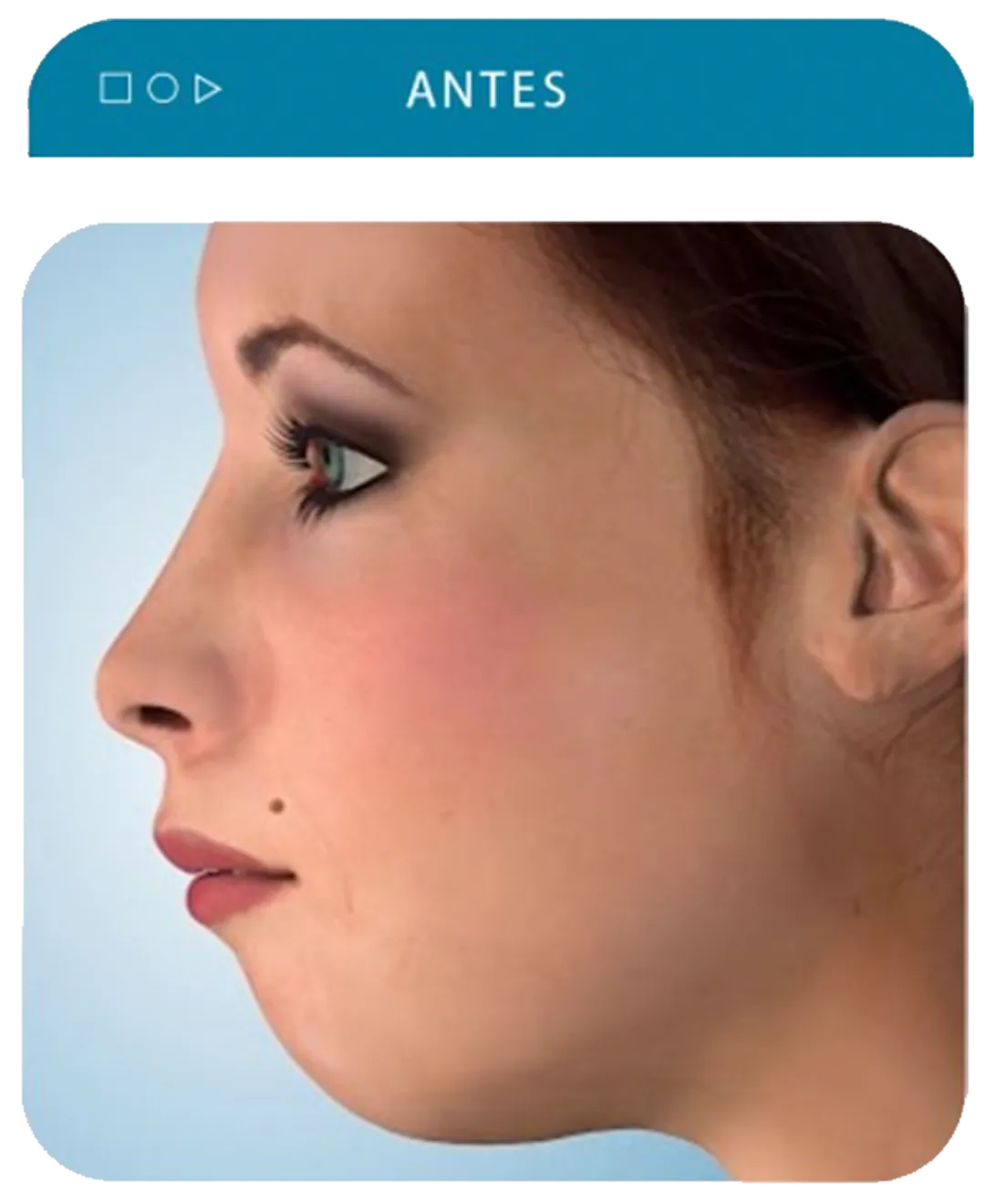 Cirurgia ortognatica antes