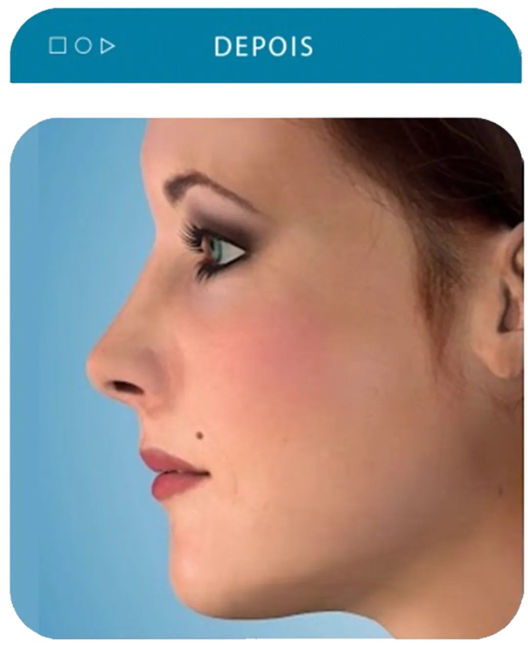 Cirurgia ortognatica depois